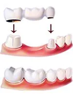 Schematic-diagram-of-dental-bridge