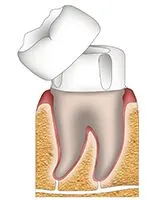 Schematic-diagram-of-dental-crown